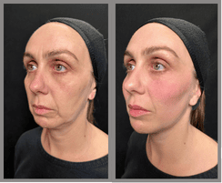 Sculptra & Skinboosters