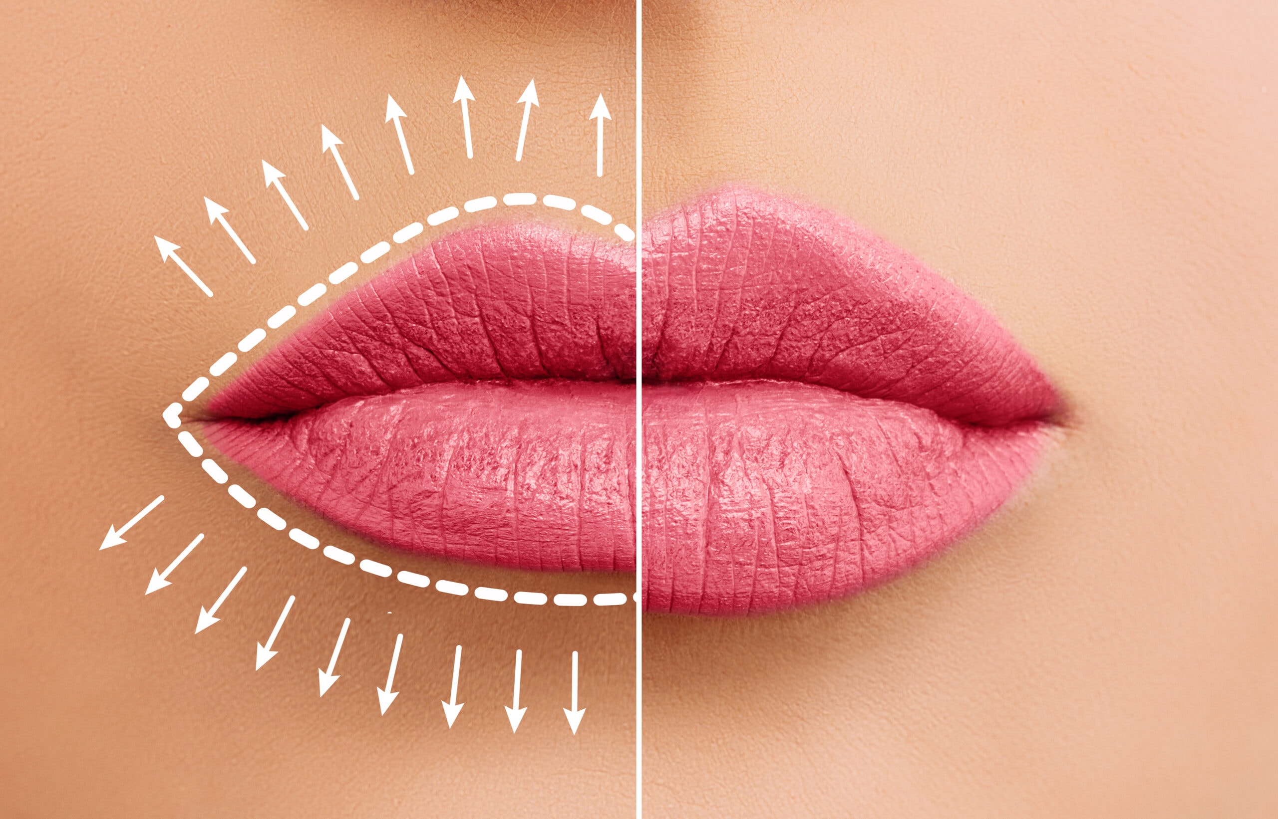 A map of showing the aesthetician where to inject the filler for the best results
